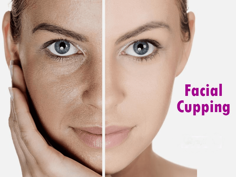 facial cupping treatment